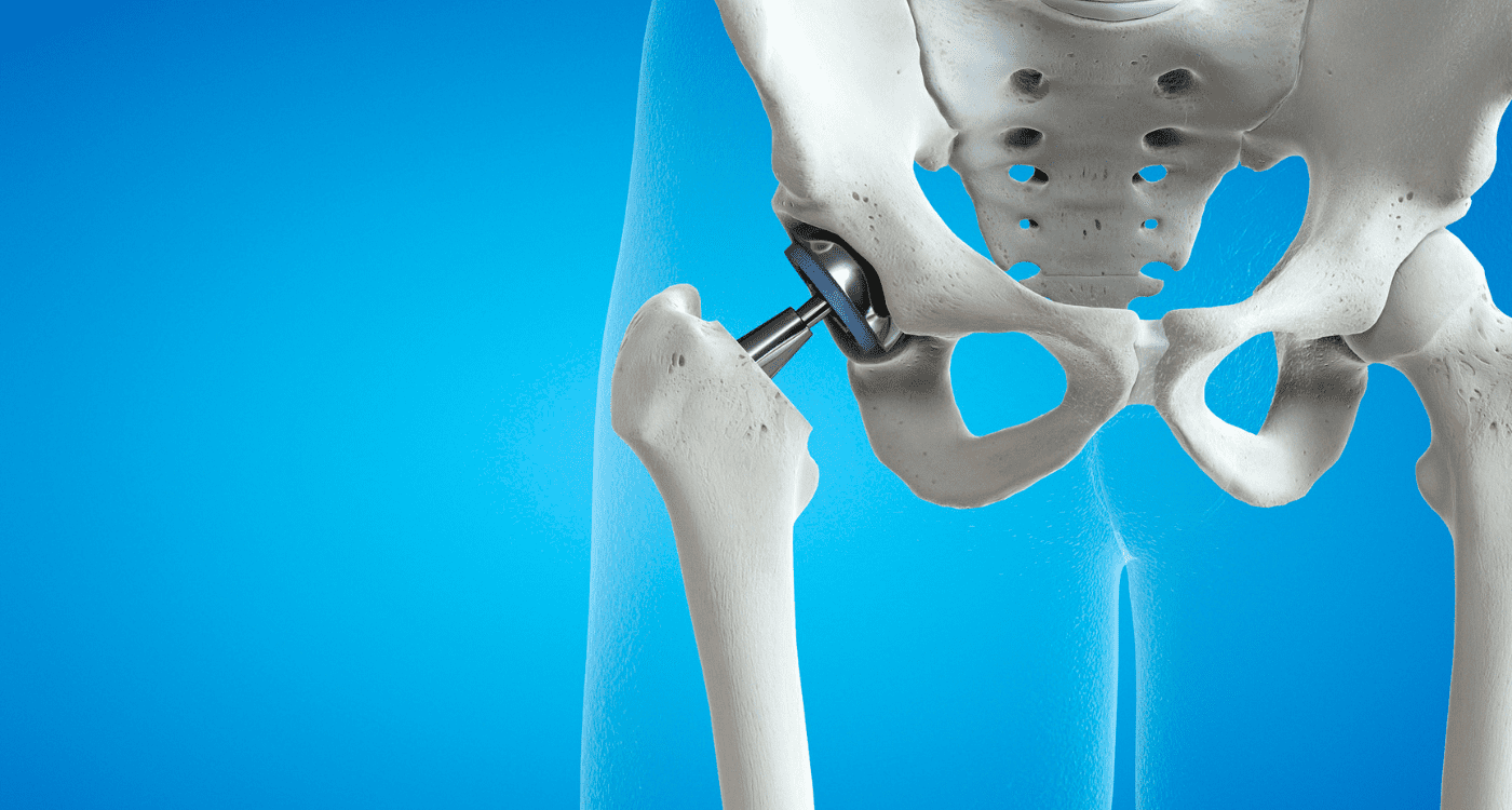 ¿Sufrió una torcedura? Especialista en esguinces en Saltillo